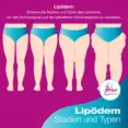 Blog Lipödem © stock.adobe.com