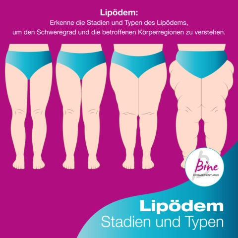 Lipödem Stadien und Typen - Foto © Pepermpron - Stock.Adobe.com