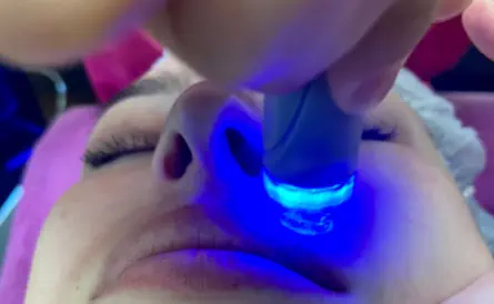 HyquaPeel Anwendung Kosmetikstudio Bine Landshut