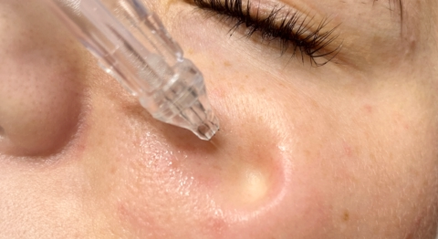 JetPeel Hydroporation - Kosmetikstudio Bine ©Foto: Sabine Eibl