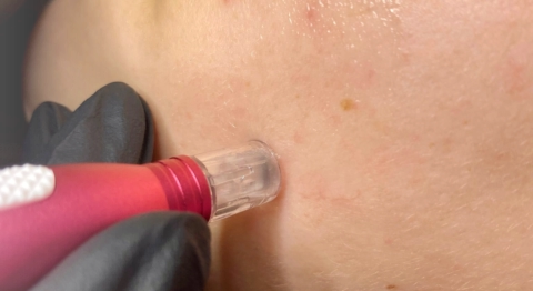 Nanoporation - Kosmetikstudio Bine © Foto: Sabine Eibl